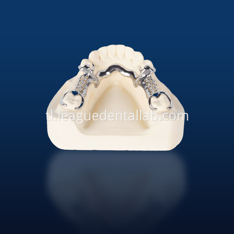 Cast partial,3D printed metal partial,Bego metal partial,cast metal framework,Vatalium Metal framework